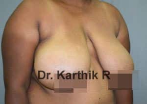 Breast Reduction and Breast Lift