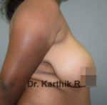 Breast Reduction and Breast Lift