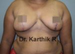 Breast Reduction and Breast Lift