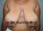 Breast Reduction and Breast Lift