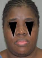 Rhinoplasty (Nose Corrections)