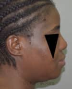 Rhinoplasty (Nose Corrections)