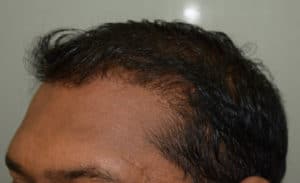 Hair Transplant