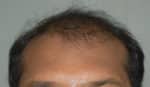 Hair Transplant