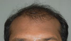 Hair Transplant