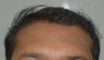 Hair Transplant