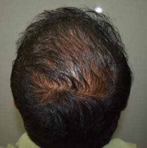 Hair Transplant