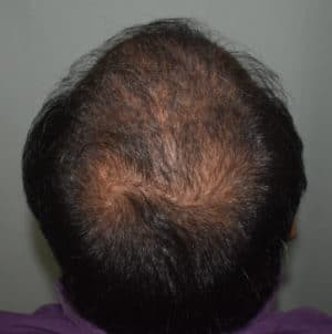 Hair Transplant