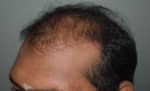 Hair Transplant