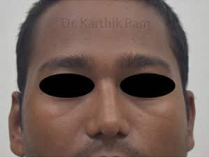 Dermal Fillers