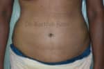 Liposuction Tummy and Back