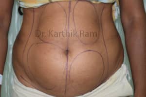 Liposuction Tummy and Back