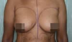 Breast Fat Fill (Breast Augmentation)