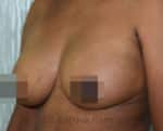 Breast Fat Fill (Breast Augmentation)