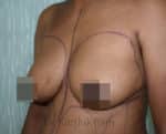 Breast Fat Fill (Breast Augmentation)