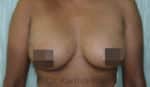 Breast Fat Fill (Breast Augmentation)