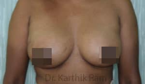 Breast Fat Fill (Breast Augmentation)