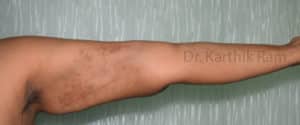 Liposuction Arms and Arm Tuck