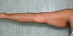 Liposuction Arms and Arm Tuck