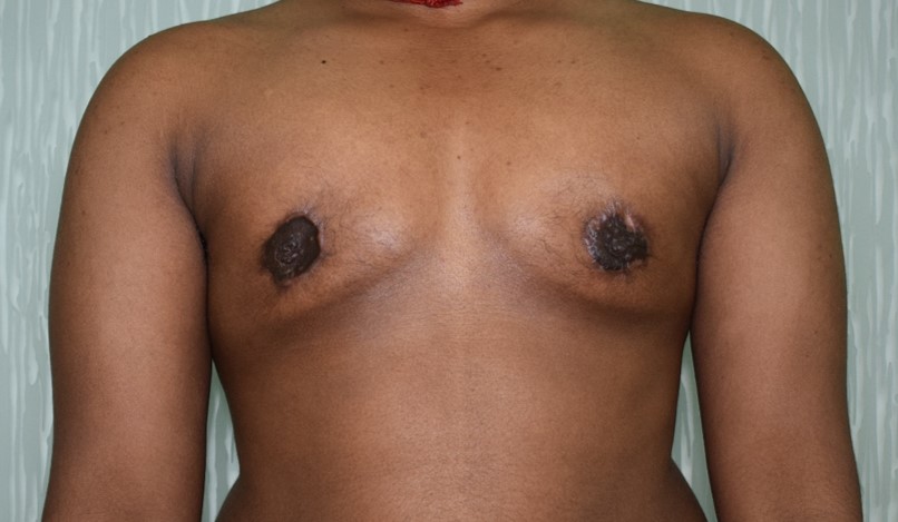 FTM Moderate Breasts