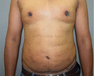 Liposuction Tummy and Back