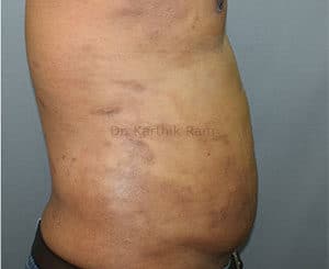 Liposuction Tummy and Back
