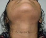 Laser Hair Reduction