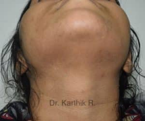 Laser Hair Reduction