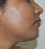 Chemical Peels & Microdermabrasion