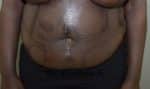 Tummy Tuck