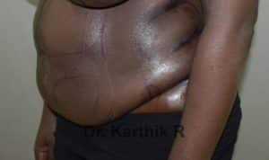 Tummy Tuck