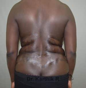 Liposuction Tummy and Back