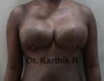 Breast Reduction and Breast Lift