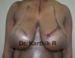 Breast Reduction and Breast Lift