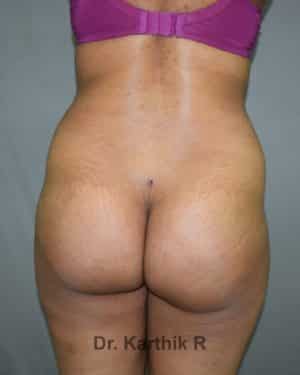 Butt Lift