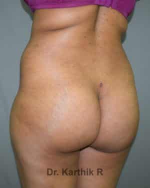Butt Lift
