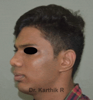 Rhinoplasty (Nose Corrections)