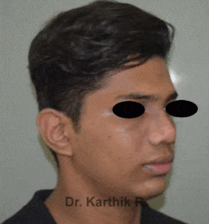Rhinoplasty (Nose Corrections)