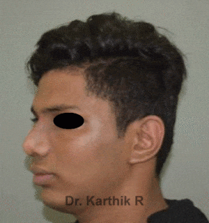Rhinoplasty (Nose Corrections)