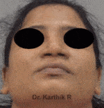 Rhinoplasty (Nose Corrections)