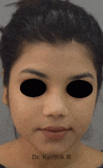 Rhinoplasty (Nose Corrections)