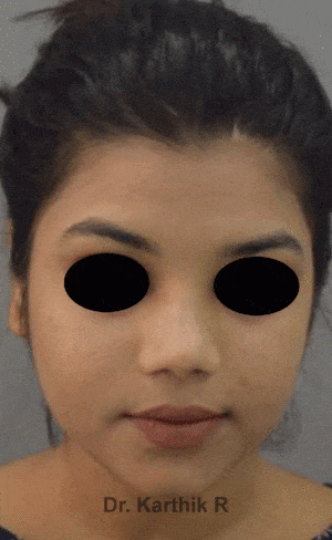 Rhinoplasty (Nose Corrections)