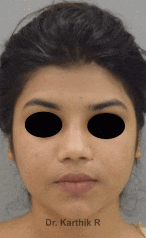 Rhinoplasty (Nose Corrections)