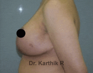 Breast Reduction and Breast Lift