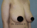 Breast Reduction and Breast Lift