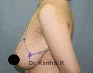 Breast Reduction and Breast Lift