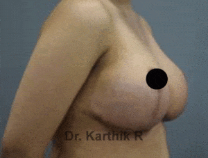 Breast Reduction and Breast Lift