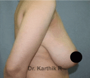 Breast Reduction and Breast Lift
