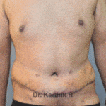 Tummy Tuck