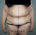 Tummy Tuck